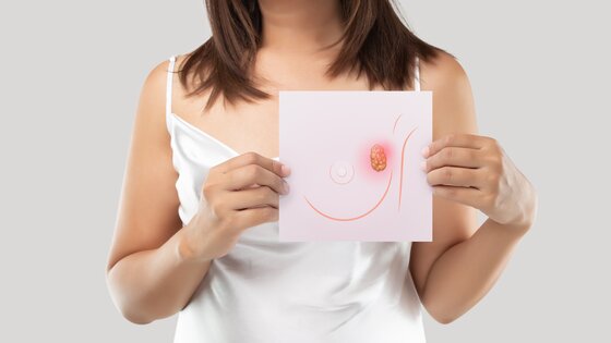 Eine Frau mit einer Darstellung eines Mammakarzinoms. | © AdobeStock_392205899