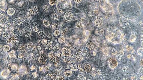 Eine mikroskopische Darstellung von Krebszellen. | © AdobeStock_522308197.jpeg