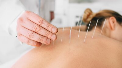 Eine Frau bei der Akkupunktur. | © AdobeStock_246370956