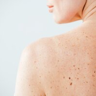 Symptome von Hautkrebs | © AdobeStock-264437535