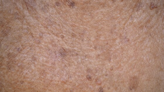 Weißer Hautkrebs ist oft nicht einfach zun erkennen | © AdobeStock-273248437