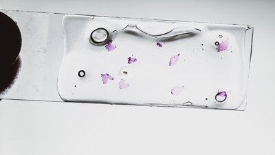 Unter dem Mikroskop lässt sich ein Angiosarkom erkennen | © AdobeStock-313210130