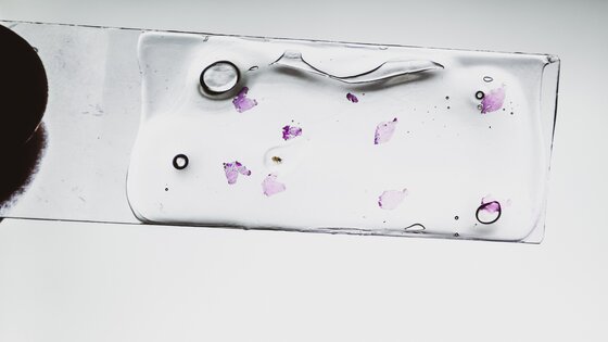 Unter dem Mikroskop lässt sich ein Angiosarkom erkennen | © AdobeStock-313210130