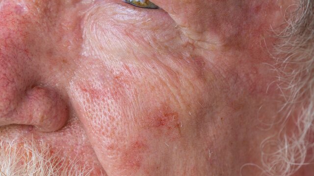 Ein Gesicht eines älteren Mannes, das auf der Wange Hautveränderungen zeigt. | © AdobeStock-322903545