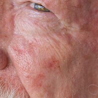 Ein Gesicht eines älteren Mannes, das auf der Wange Hautveränderungen zeigt. | © AdobeStock-322903545