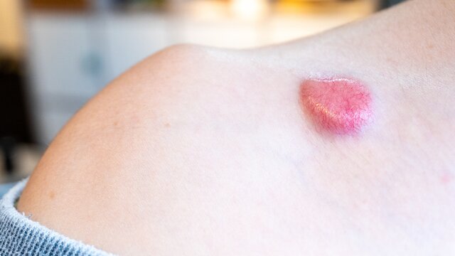 Ein Kutanes Sarkom auf dem Rücken einer jüngeren Frau. | © AdobeStock-408207265