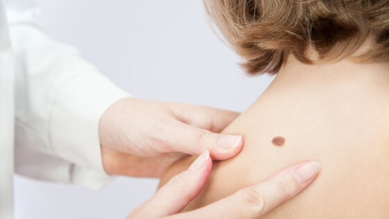 Hautärzt:innen untersuchen Laberflecke auf Veränderungen | © AdobeStock-169145358