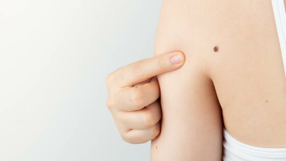 Ein Frau zeigt mit einem Finger auf ein Melanom an ihrer Schulter | © AdobeStock-497522511