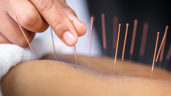 Akupunktur ist eine alternative Heilmethode. | © AdobeStock_281352628