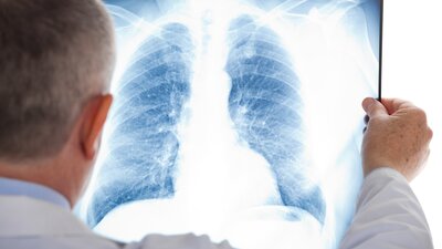 Ein Arzt betrachtet das Röntgenbild einer Lunge. | © AdobeStock_54940412