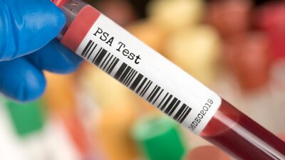 Eine Blutprobe für den PSA-Test. | © AdobeStock_307042175