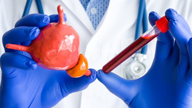 Ein Arzt hält ein Modell der Prostata und eine Blutprobe. | © AdobeStock_271239323